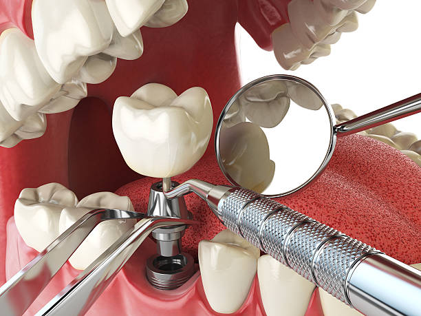 Best Urgent Care for Lost Fillings or Crowns in Shirley, NY